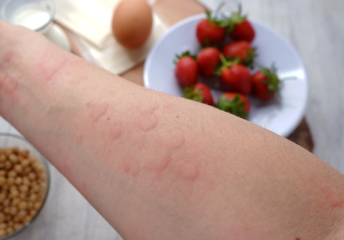 The Truth About Anaphylaxis and Food Allergies